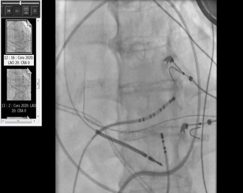 AUBMC Cardiac Arrhythmia Team Performs a Unique Procedure Controlling Heart Beat Disorder without Surgery